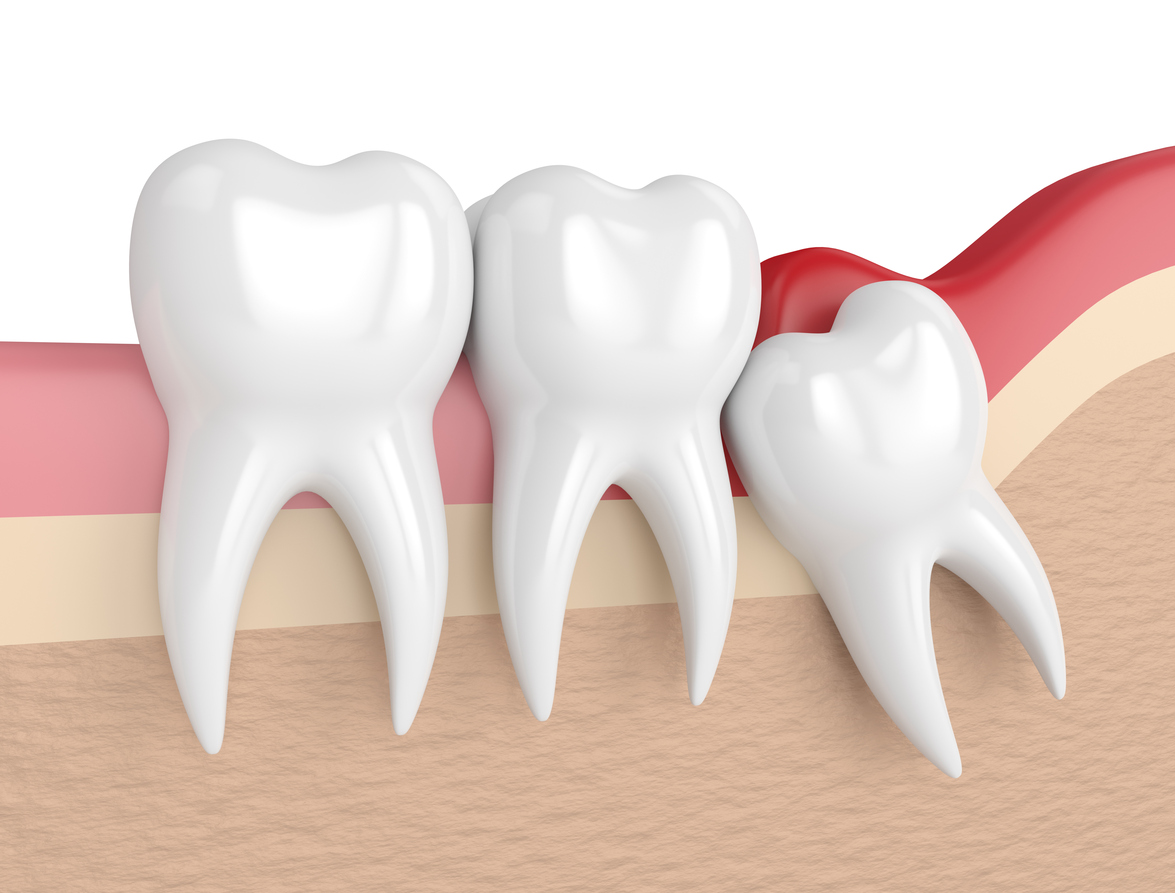 overcrowding due to wisdom teeth