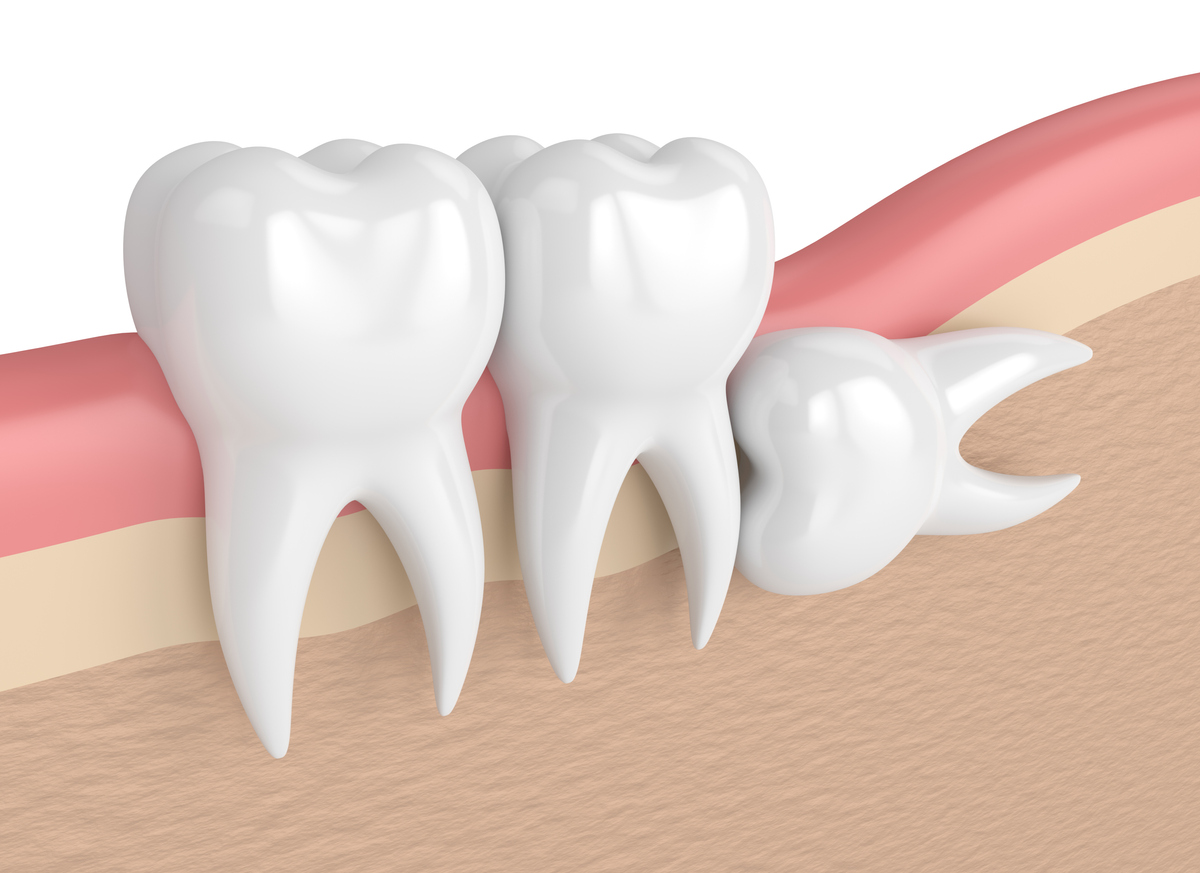 Wisdom teeth facts