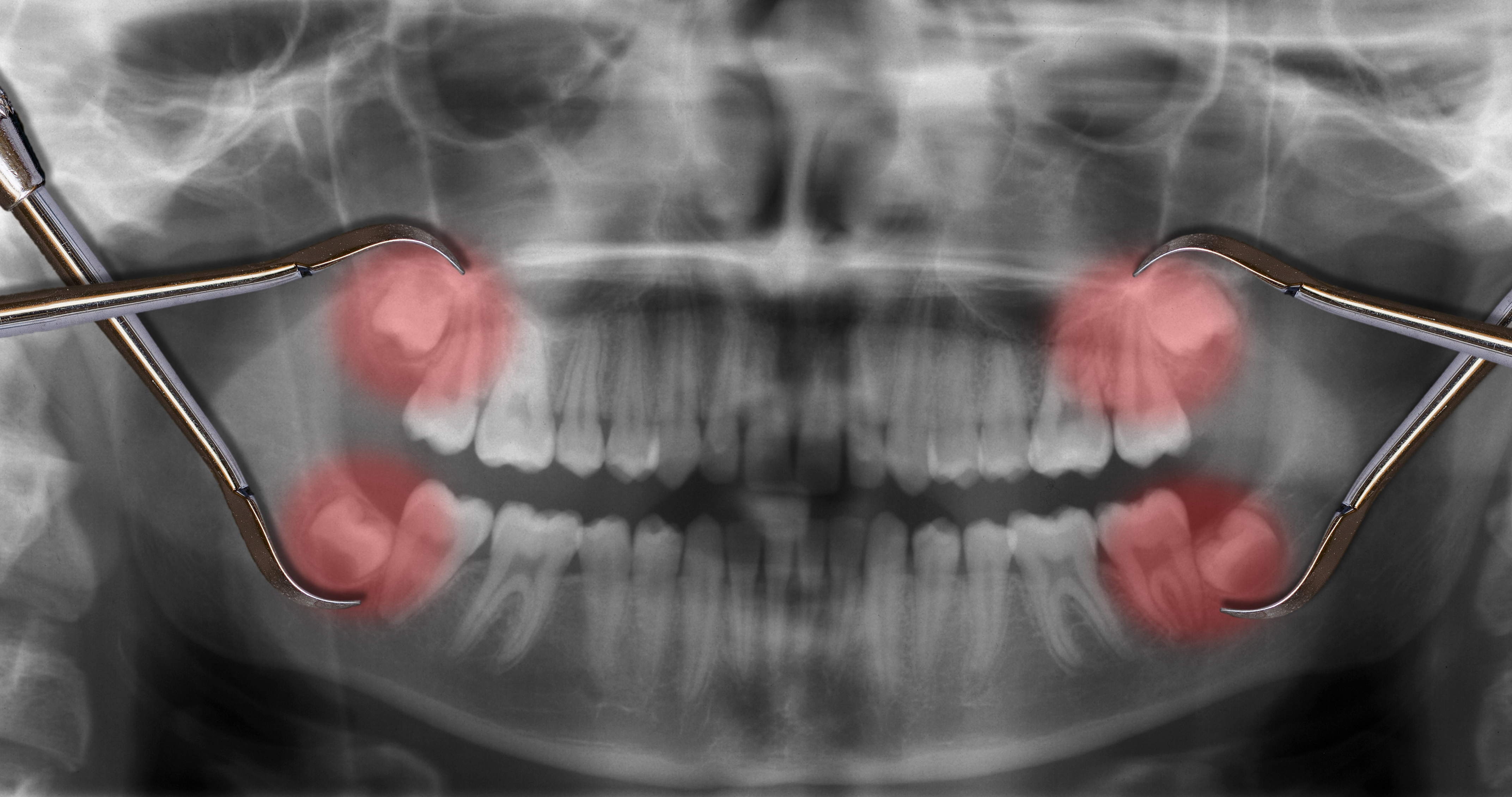 wisdom teeth vestigial