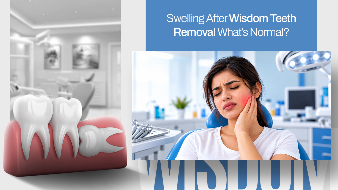 Person applying an ice pack to a swollen cheek after wisdom teeth removal